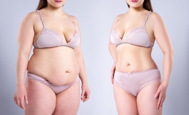 Liposuction Versus Bbl: Choosing Your Body Contouring Journey