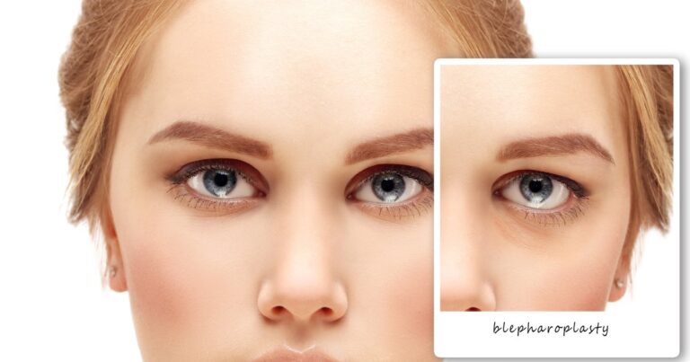 Lower Lid Blepharoplasty With Fat Transfer