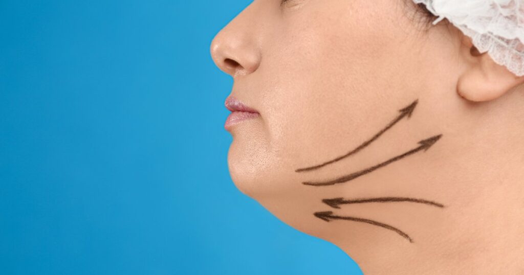 Minimizing Risks Of Double Chin Liposuction