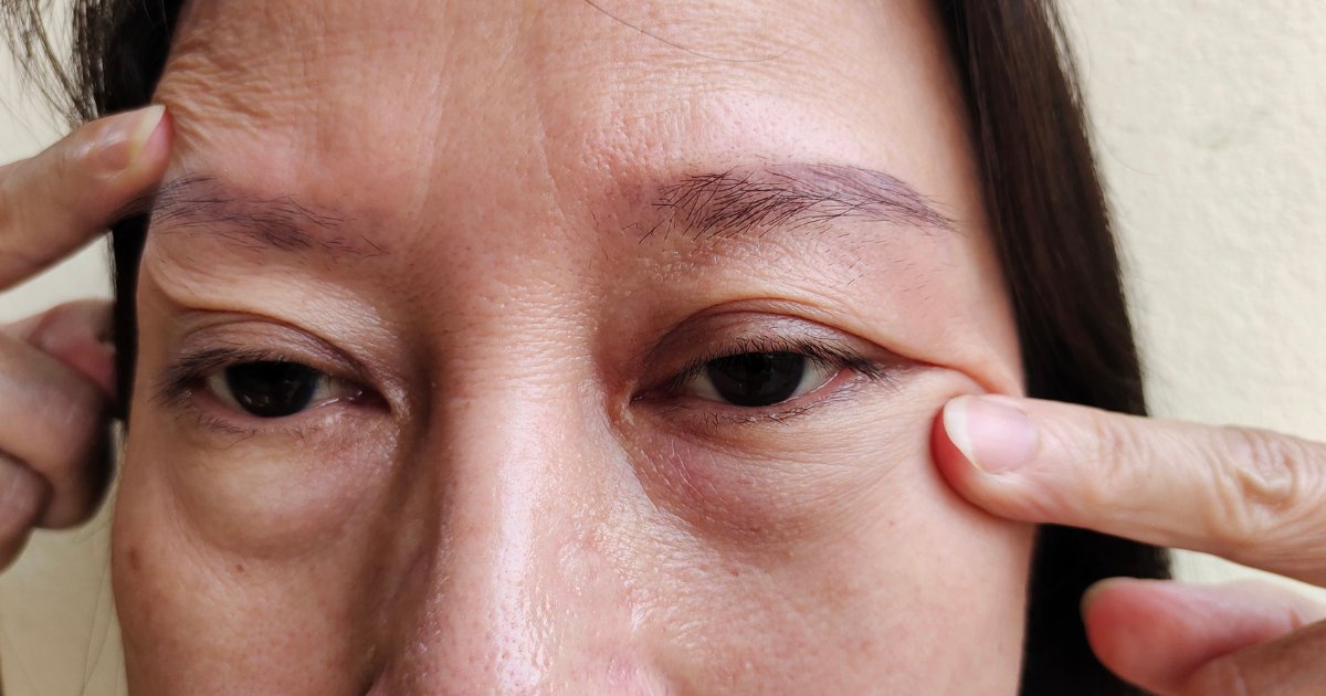 Ptosis And Blepharoplasty