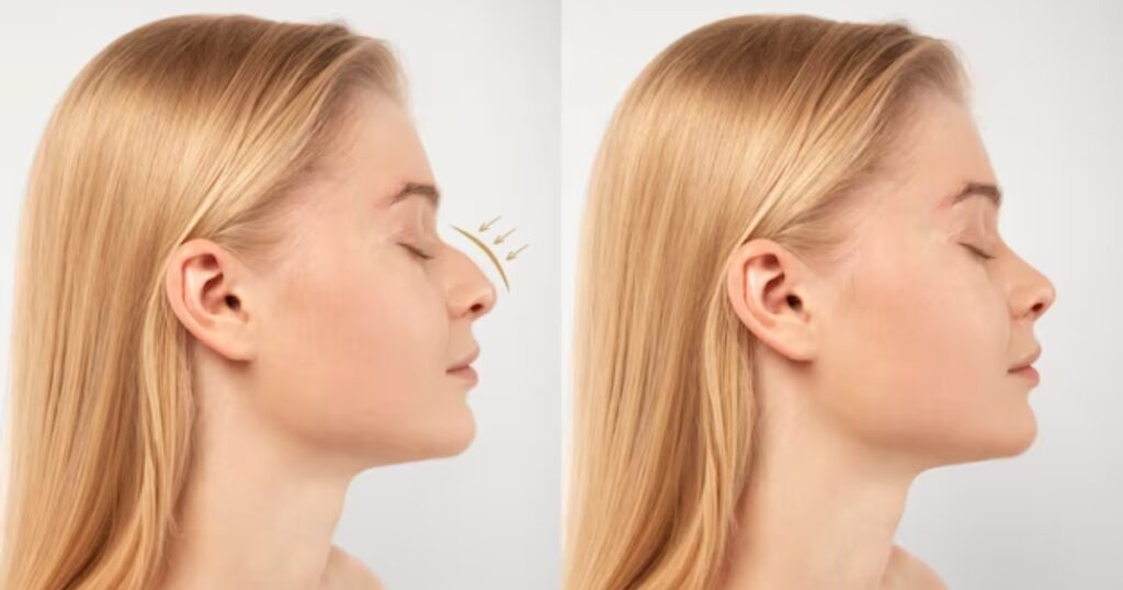 What Can I Expect After Rhinoplasty Surgery