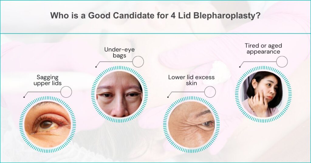 Who Is A Good Candidate For 4 Lid Blepharoplasty