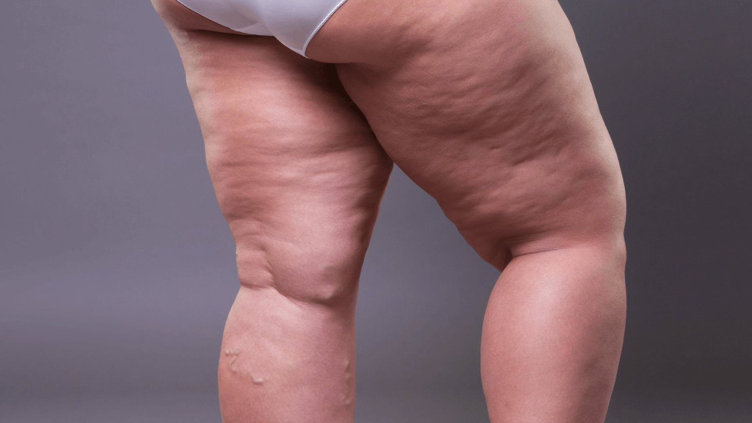 Does Thigh Liposuction Get Rid Of Cellulite?