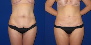 Tummy Tuck And Liposuction Before And After