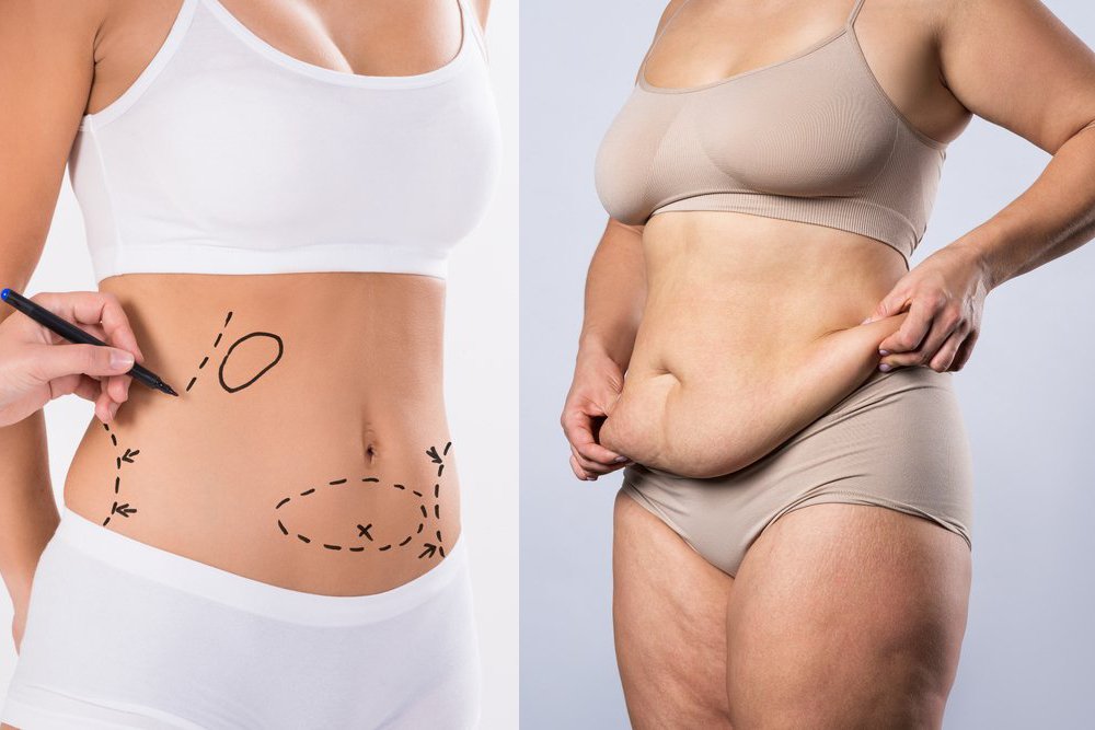 Which Is More Painful Liposuction Or Tummy Tuck