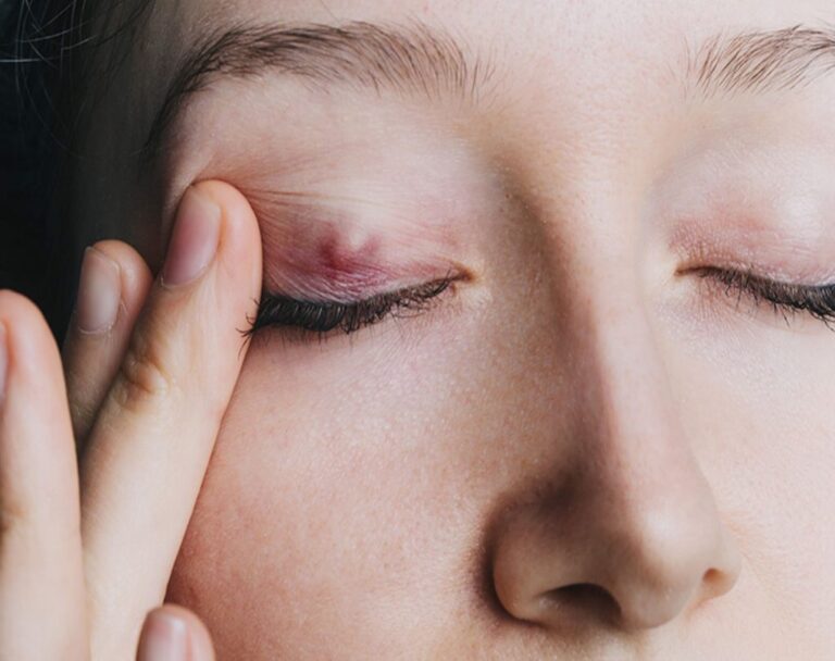 Chalazion Surgery Cost Near Me: A Comprehensive Guide