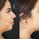 Does Jaw Filler Reduce Double Chin