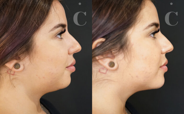 Does Jaw Filler Reduce Double Chin? All You Need To Know