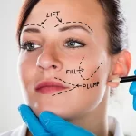 Facelift Surgery What Is It