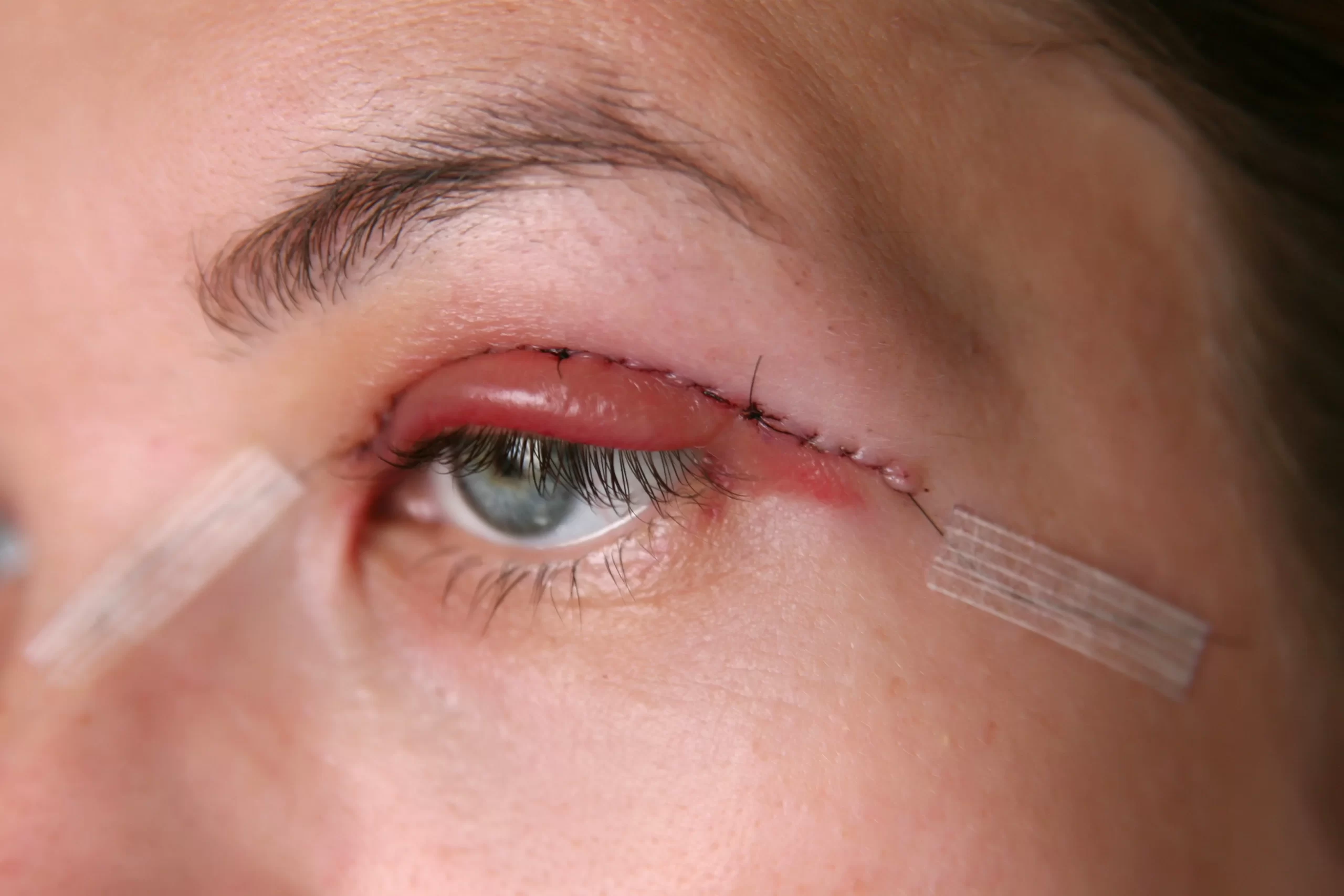 How Long Does Eyelid Surgery Take
