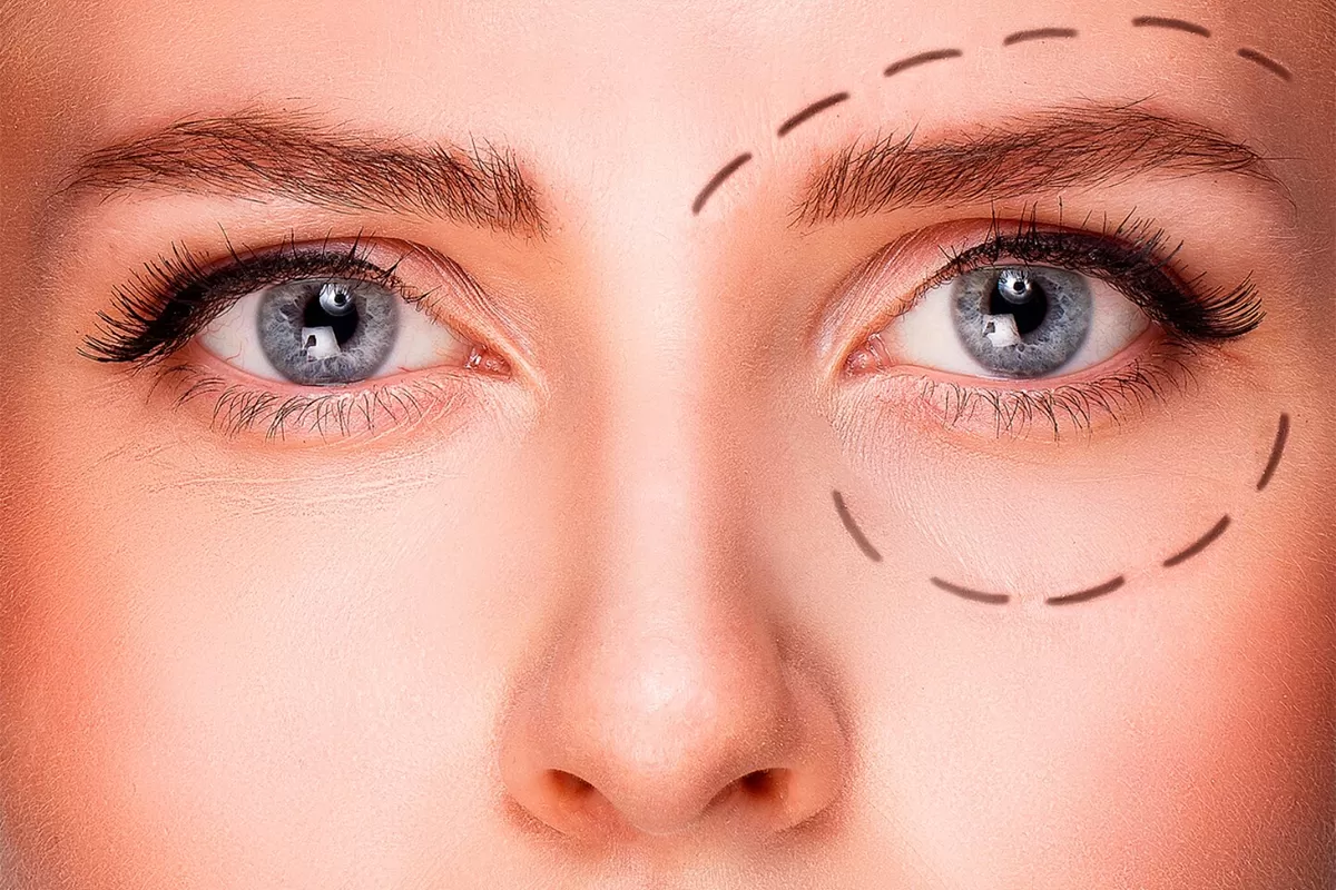 Ptosis Correction Without Surgery