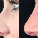 What Is Filler Rhinoplasty