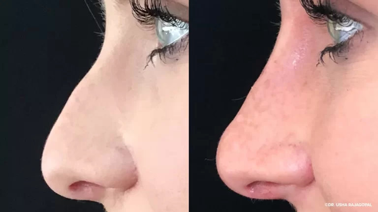 What Is Filler Rhinoplasty? Your Comprehensive Guide