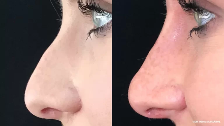 What Is Filler Rhinoplasty