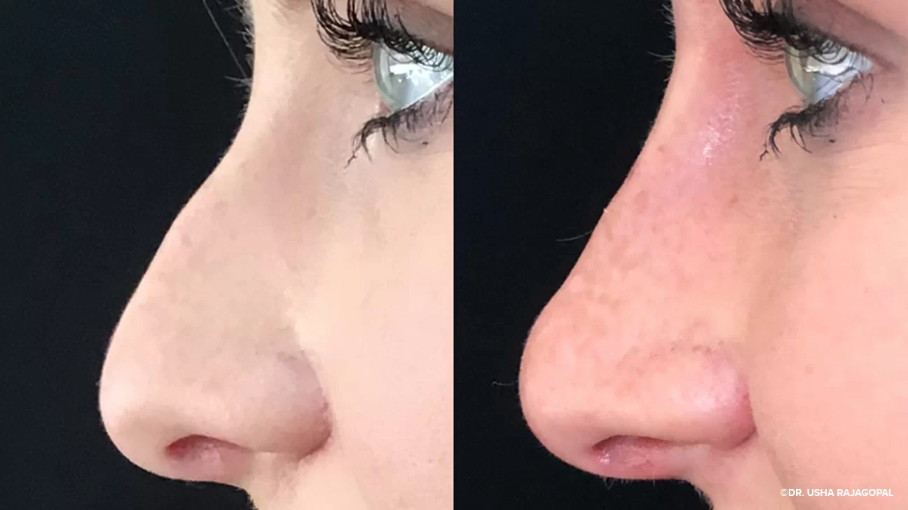 What Is Filler Rhinoplasty