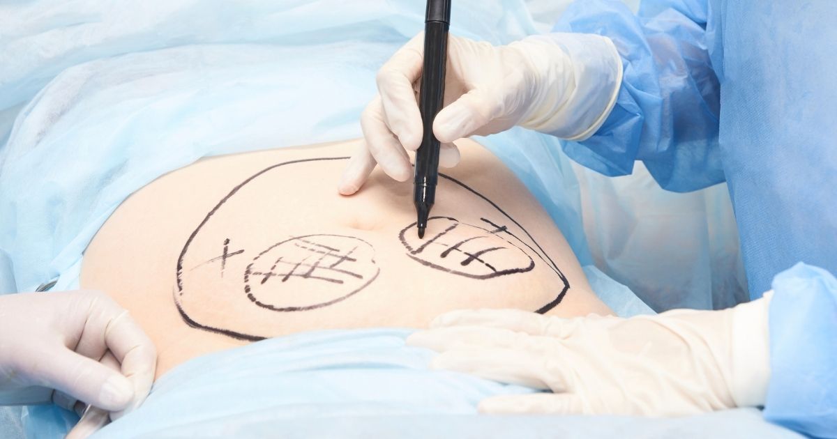 Best Plastic Surgeon Near Me For Tummy Tuck