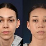Body Feminization Surgery Before And After Eyelid Surgery