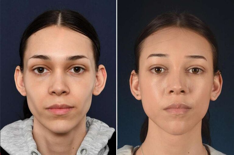 Body Feminization Surgery Before And After 2