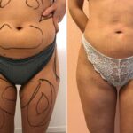 Body Feminization Surgery Cost Belly Fat Removal Surgery Cost In Dubai