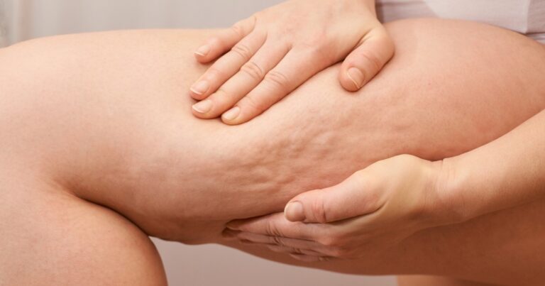 Does Liposuction Help With Cellulite