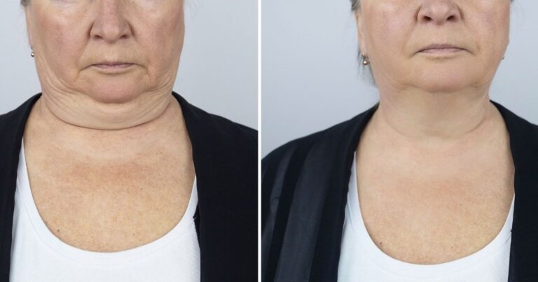 How Much Neck Liposuction Cost