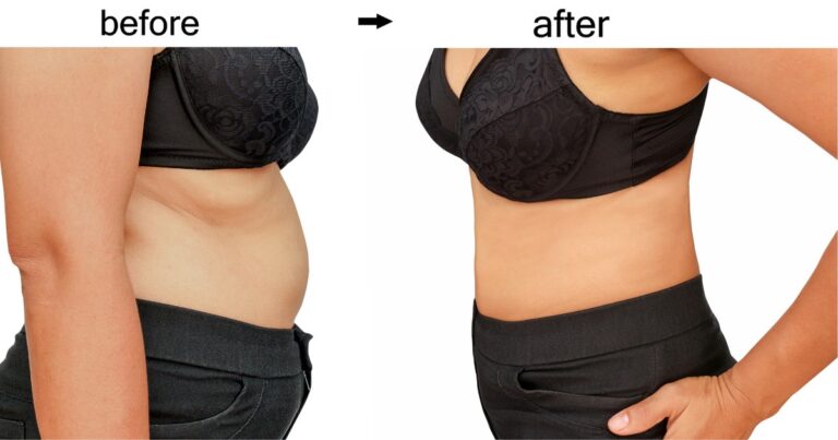 Liposuction Abdomen Before And After