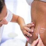 Plastic Surgery For Stretch Marks Interview