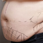 When Does Liposuction Swelling Go Down Cheek Augmentation