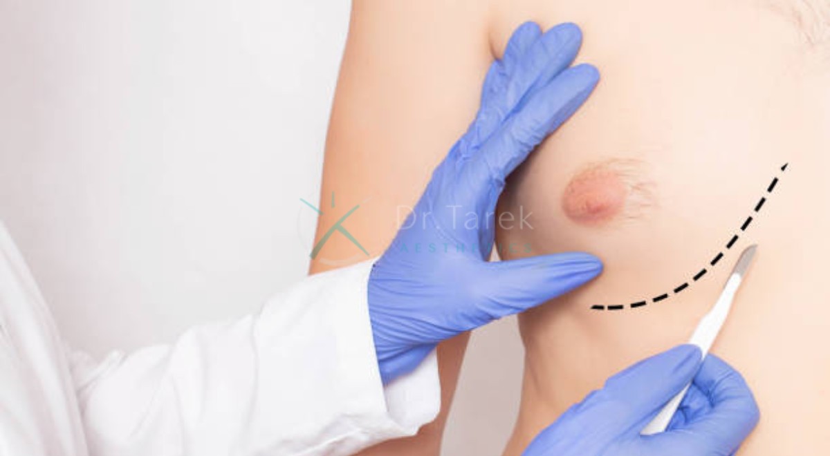 Plastic Surgeon For Gynecomastia An Overview By Dr. Tarek