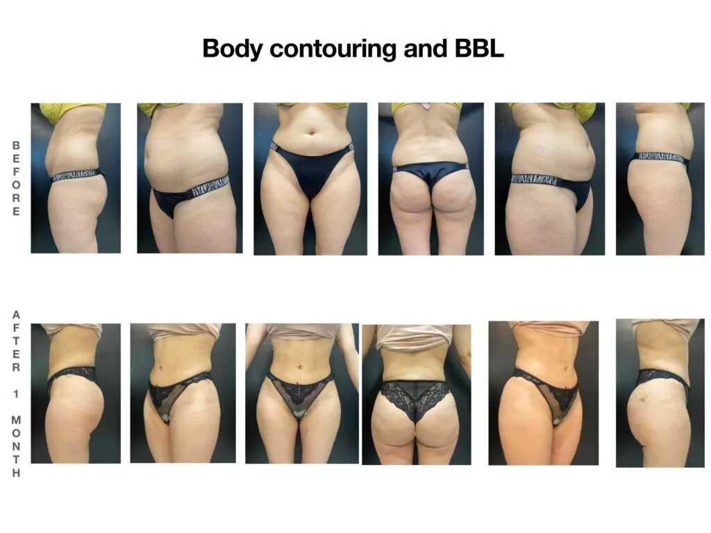 
Body-Contouring-And-Bbl-1024X768-1