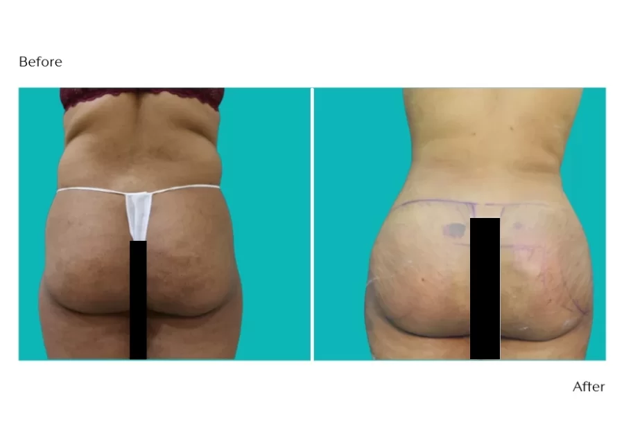 Body Contouring And Bbl Gallery
