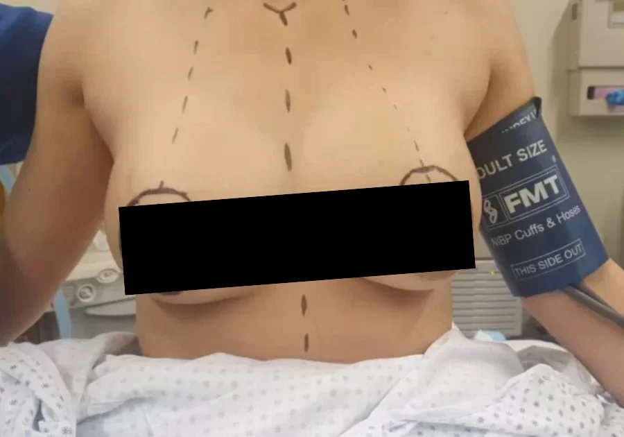 Breast Lift Gallery