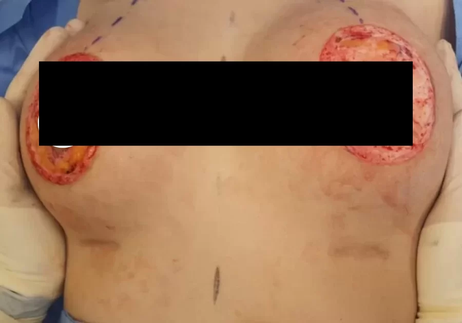 Breast Lift Gallery