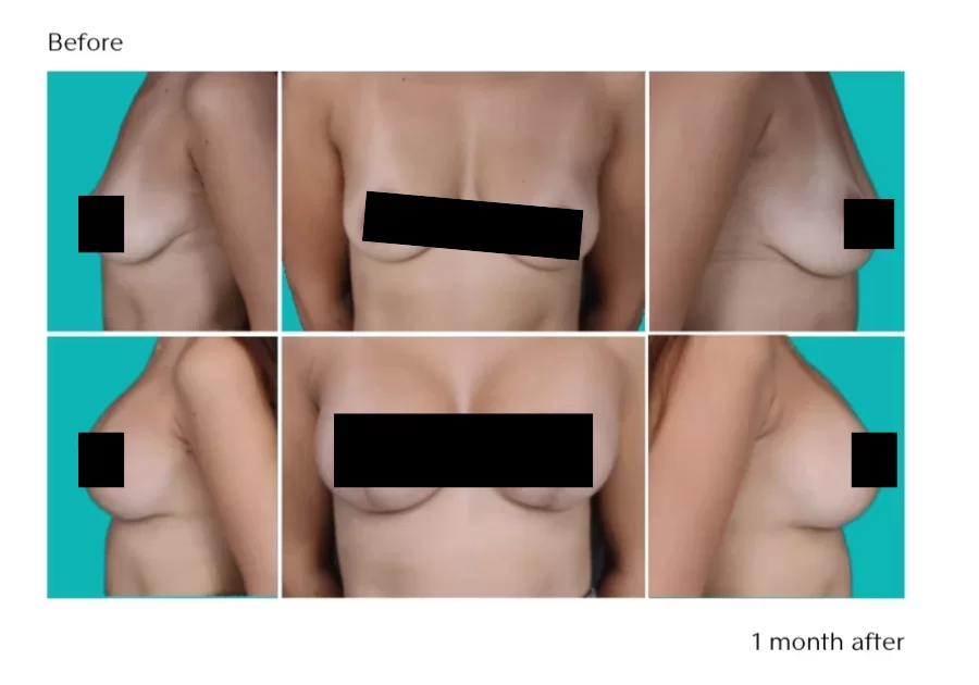 Breast Lift Gallery