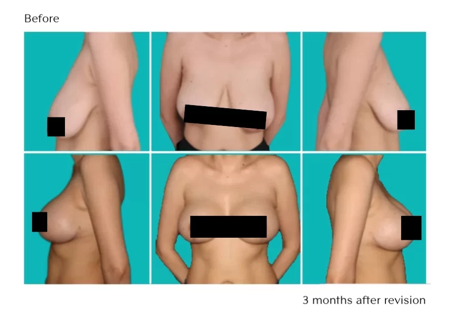 Breast Lift Gallery