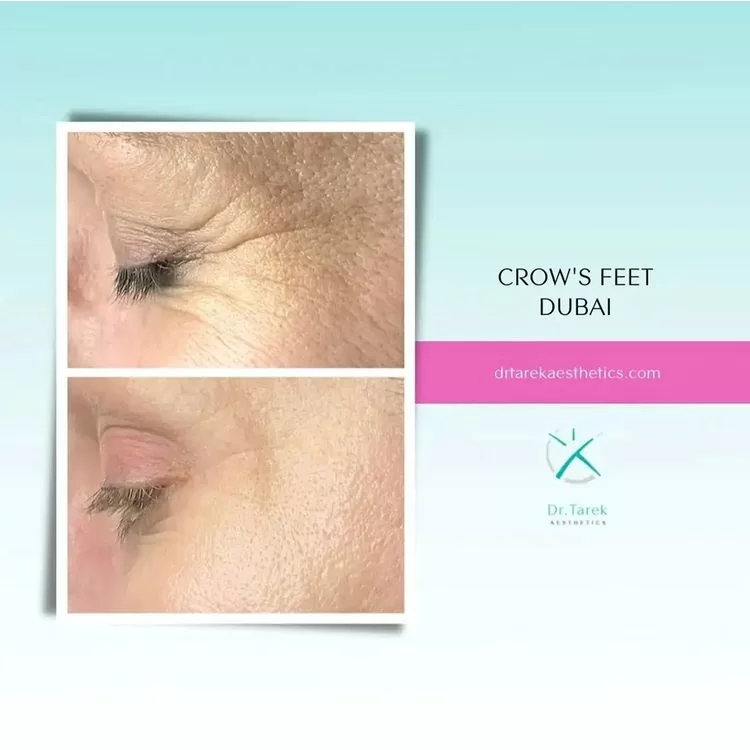 Prp | Platelet Rich Plasma