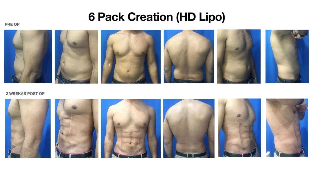 High Definition Liposuction Gallery
