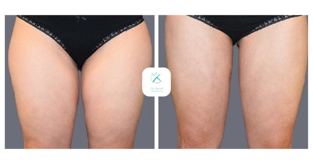 Thigh Liposuction Before And After 1