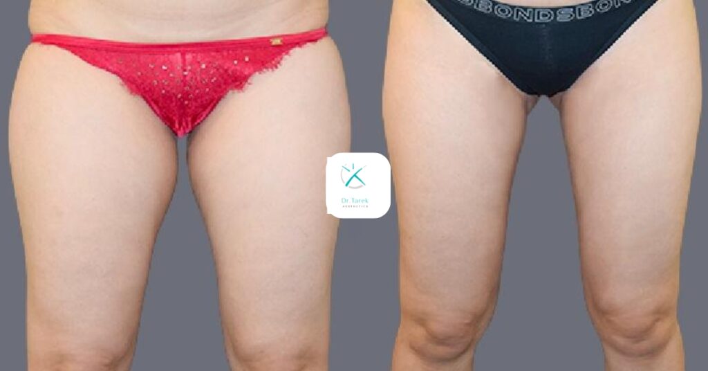 Thigh Liposuction Before And After 2