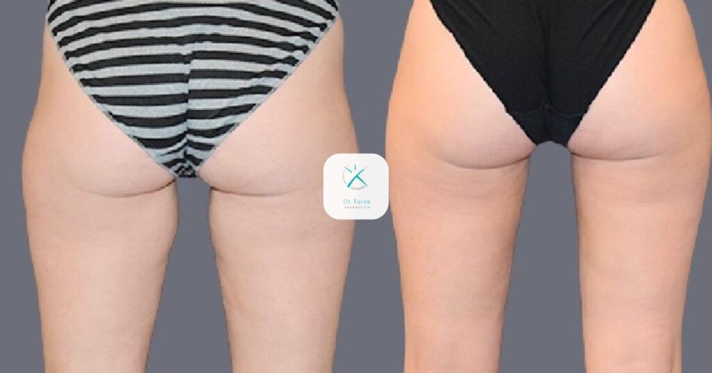 Thigh Liposuction Before And After 3