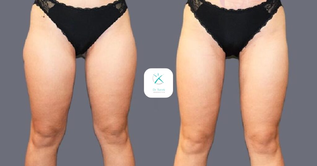 Thigh Liposuction Before And After 4
