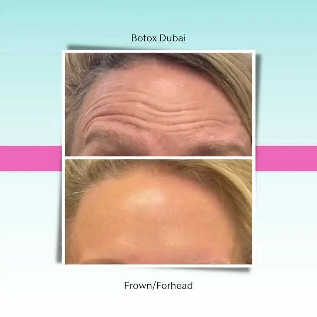 Prp | Platelet Rich Plasma