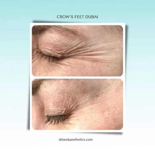 Prp | Platelet Rich Plasma