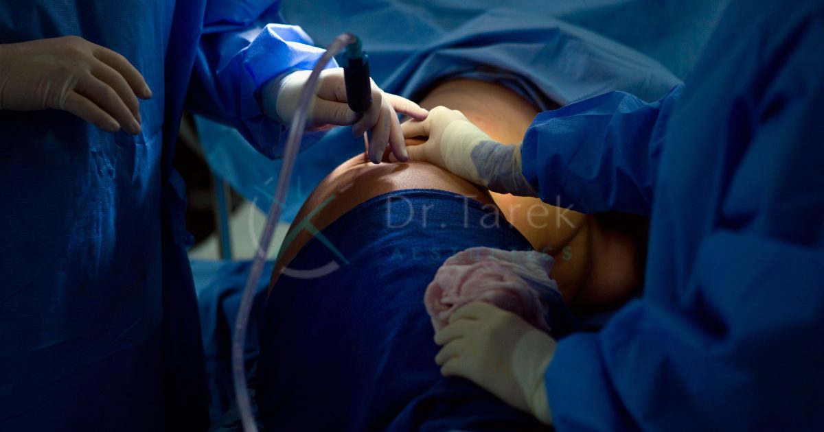 Can-I-Perform-Liposuction-Myself