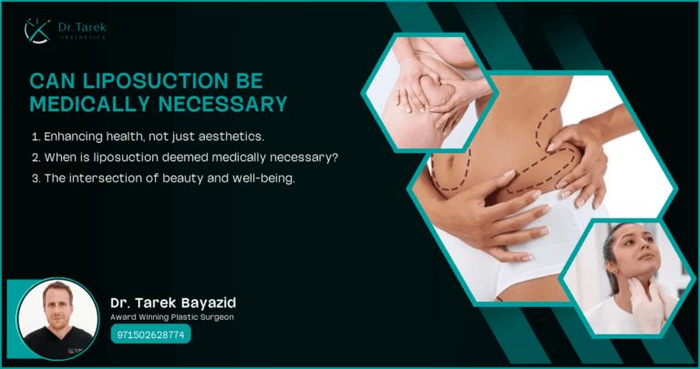 Can-Liposuction-Be-Medically-Necessary