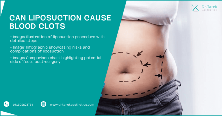 Can-Liposuction-Cause-Blood-Clots