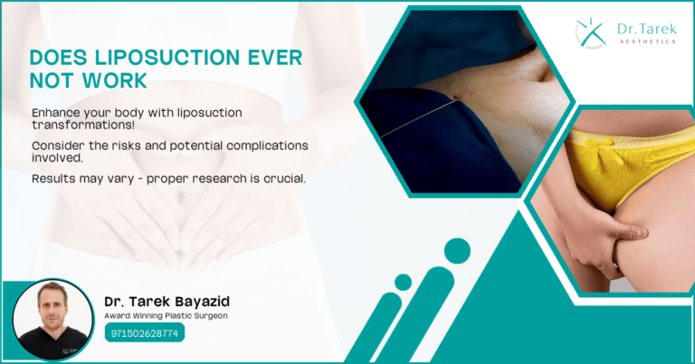 Does-Liposuction-Ever-Not-Work