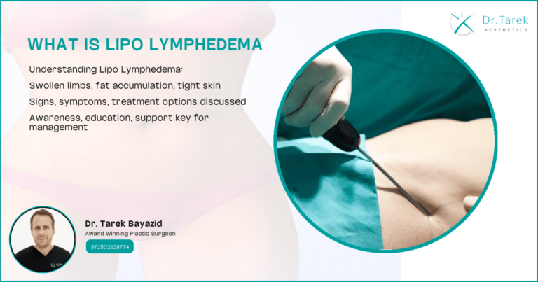 What-Is-Lipo-Lymphedema