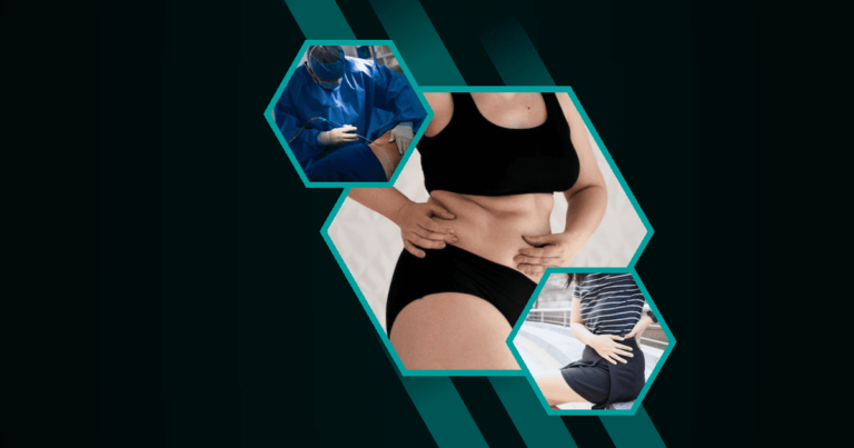 Can-Liposuction-Fix-Hip-Dips