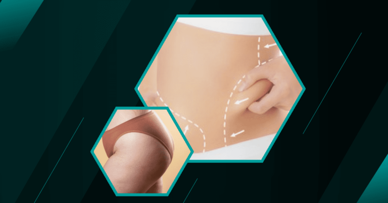 Can-Liposuction-Get-Rid-Of-Visceral-Fat